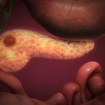 OVA 4 SIMPTOMA UKAZUJU DA IMATE RAK PANKREASA! Svrab je jedan od njih – a tek da čujete ostala tri OVA 4 SIMPTOMA UKAZUJU DA IMATE RAK PANKREASA! Svrab je jedan od njih - a tek da čujete ostala tri - featured image