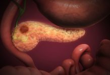 OVA 4 SIMPTOMA UKAZUJU DA IMATE RAK PANKREASA! Svrab je jedan od njih – a tek da čujete ostala tri OVA 4 SIMPTOMA UKAZUJU DA IMATE RAK PANKREASA! Svrab je jedan od njih - a tek da čujete ostala tri - featured image